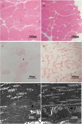 Clinical Presentations and Genetic Characteristics of Late-Onset MADD Due to ETFDH Mutations in Five Patients: A Case Series